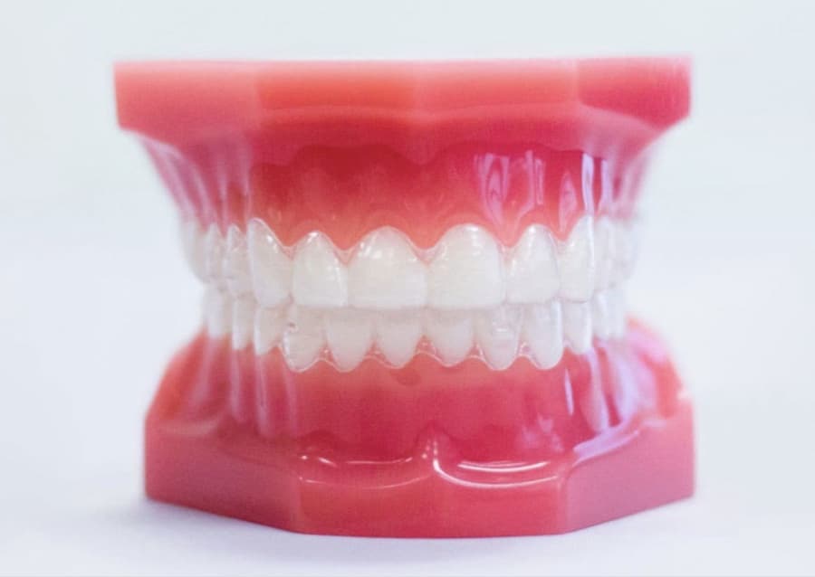 clear aligners on model