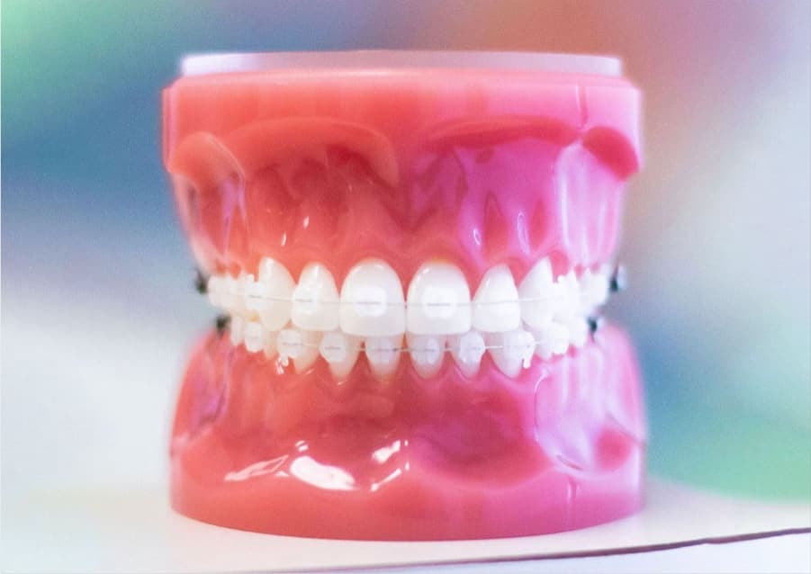 claer braces on model