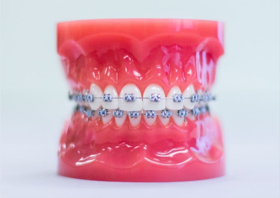 metal braces on model